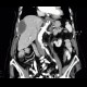 Subdiaphragmatic abscess, abscess: CT - Computed tomography